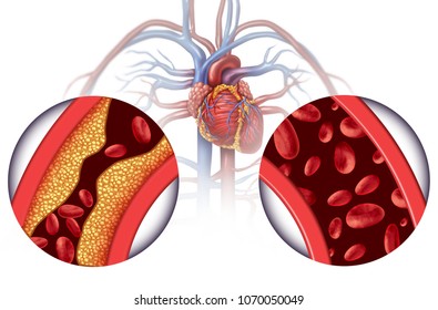 Chelation Therapy And Heart Disease Treatment Concept As An Alternative Medicine For Human Blood Circulation Disease With 3D Illustration Elements.