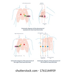 The Chest Electrode Of ECG Includes Conventional Chest Lead, Posterior Wall Lead And Right Ventricular Lead. The Placement Of Chest Lead Electrode Shall Comply With The Specification.