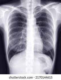 Chest Xray Image Screening Diagnosis Tbtuberculosis Stock Illustration ...