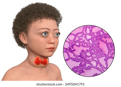 A child with Graves' disease, 3D illustration displaying enlarged thyroid gland (goiter) and bulging eyes (exophthalmos), along with a light micrograph of a toxic goiter. - Powered by Shutterstock