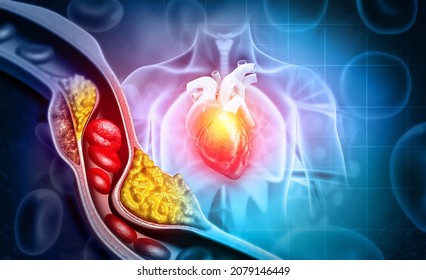 Cholesterol Blocked Artery With Heart. 3d Illustration