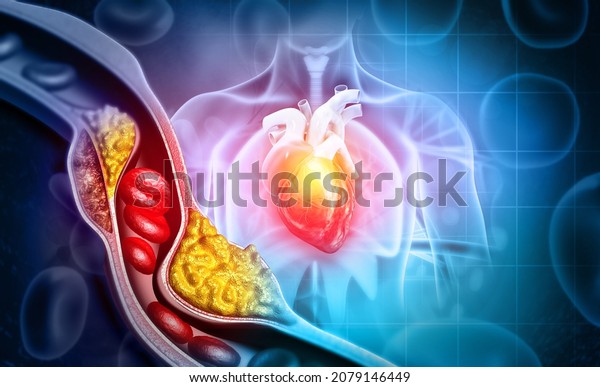 Cholesterol\
blocked artery with heart. 3d\
illustration