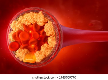 Cholesterol in the blood vessels. Atherosclerosis disease 3D illustration: atherosclerotic plaque, blood cells, red background. High LDL cholesterol in the arteries. Health risk, blood press control