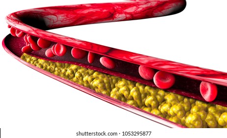 Cholesterol formation, fat, artery, vein, heart. Narrowing of a vein for fat formation. 3d rendering