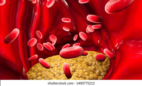 Cholesterol formation, fat, artery, vein, heart. Red blood cells, blood flow. Narrowing of a vein for fat formation. 3d render