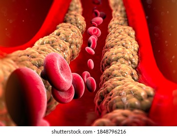 Cholesterol formation, fat, artery, vein, heart. Red blood cells, blood flow. Narrowing of a vein for fat formation. Surgery operation, 3d render