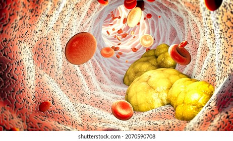 Cholesterol formation, fat, artery, vein, heart. Red blood cells, blood flow. Narrowing of a vein for fat formation. 3d rendering