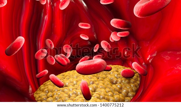 Cholesterol formation, fat, artery, vein, heart.\
Red blood cells, blood flow. Narrowing of a vein for fat formation.\
3d render