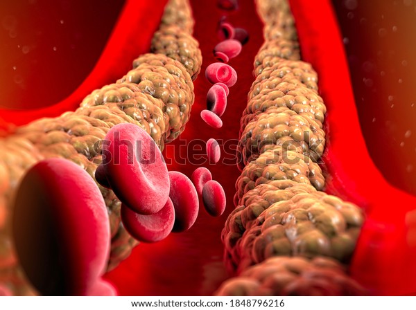 Cholesterol formation, fat, artery, vein, heart.\
Red blood cells, blood flow. Narrowing of a vein for fat formation.\
Surgery operation, 3d\
render