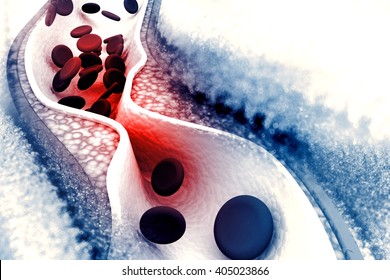 Cholesterol Plaque In Artery