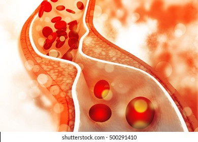 Cholesterolplatte in der Arterie