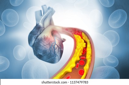 Cholesterol plaque in artery with Human heart anatomy. 3d illustration  