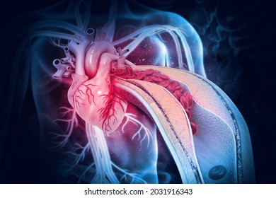 Cholesterol Plaque In Artery With Human Heart Anatomy. 3d Illustration