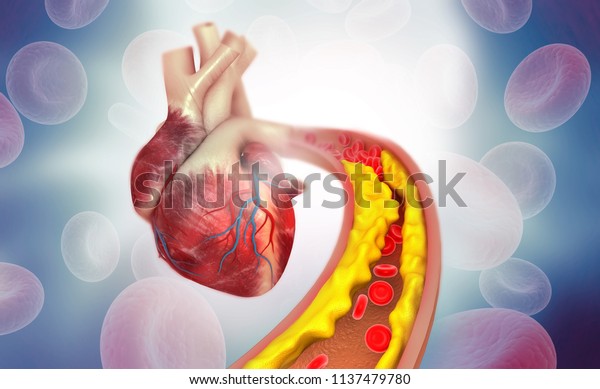 Cholesterol plaque in artery with Human heart anatomy.\
3d illustration \
