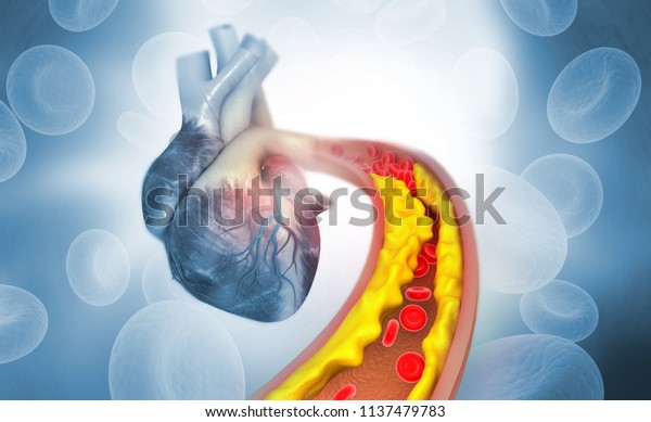 Cholesterol plaque in artery with Human heart anatomy.
3d illustration 
