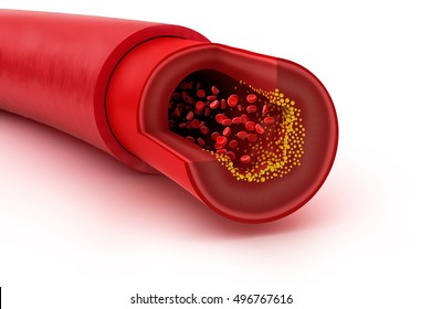 Cholesterol Plaque In Blood Vessel, 3D Illustration