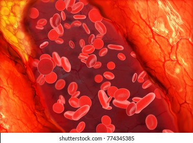 Cholesterol Plaque In Blood Vessel, 3d Rendering