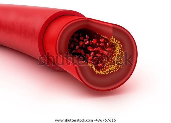 Cholesterol Plaque Blood Vessel 3d Illustration Stock Illustration