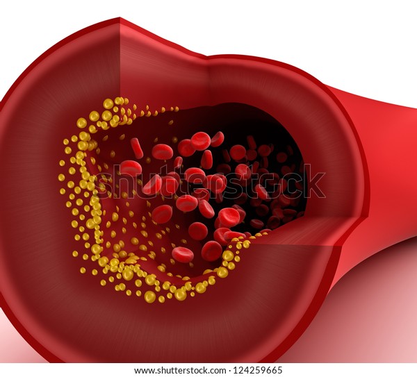 Cholesterol Plaque Blood Vessel Stock Illustration 124259665