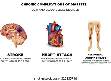 Chronic complications of Diabetes. Heart and blood vessel problems, Stroke, Heart attack and peripheral artery disease. 