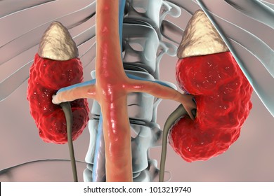 Chronic kidney disease, 3D illustration showing diseased kidney with adrenal glands, urethers, blood vessels and skeleton
