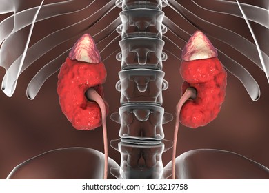 1,494 Chronic renal failure Images, Stock Photos & Vectors | Shutterstock