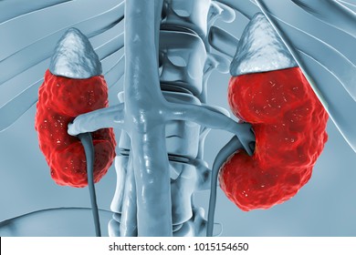 Chronic kidney disease, 3D illustration showing diseased kidney with adrenal glands, urethers, blood vessels and skeleton