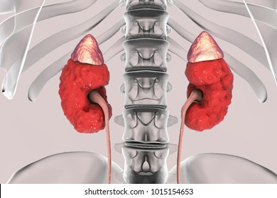 Chronic kidney disease, 3D illustration showing diseased kidney with adrenal glands, urethers and skeleton