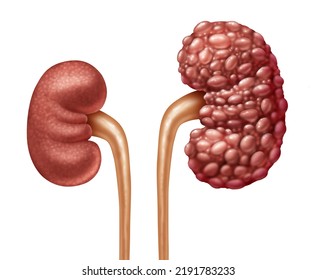 Chronic Kidney Disease Or CKD As Human Kidneys Concept As One Healthy And Polycystic Disease With Cysts As Anatomy Of The Urinary System On With A White Background In A 3D Illustration Style.