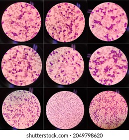 Chronic Lymphocytic Leukemia (CLL) Red Blood Cell. Blood Smear