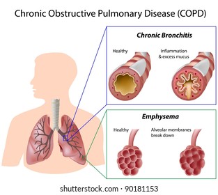 Chronic Obstructive Pulmonary Disease