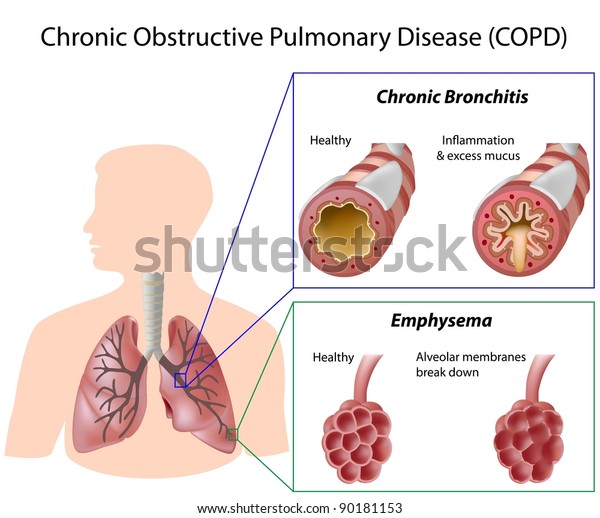 Chronic Obstructive Pulmonary Disease Stock Illustration 90181153