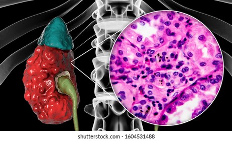 300 Interstitial cell Images, Stock Photos & Vectors | Shutterstock