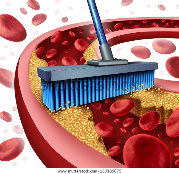 血栓動脈内に蓄積した粥腫を除去する箒としての動脈清掃のコンセプトで コレステロールを除去するための比喩として アテローム性動脈硬化 症の治療口の詰まった静脈を象徴する のイラスト素材