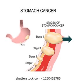 The Clinical Stages Of Stomach Cancer. Classification Of Malignant Tumours. Illustration For Medical Use