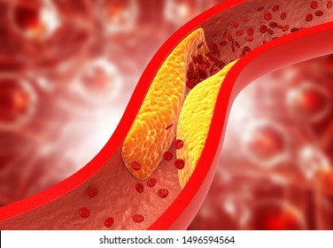 Clogged arteries, Cholesterol plaque in artery. 3d illustration