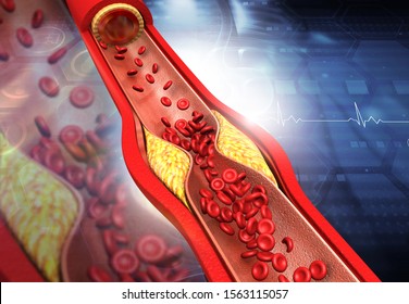 Clogged Arteries, Cholesterol Plaque In Artery. 3d Illustration	