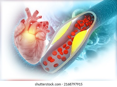 Clogged Arteries With Human Heart. Heart Attack. 3d Illustration	