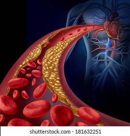 Clogged Artery And Atherosclerosis Disease Medical Concept With A Three Dimensional Human Artery With Blood Cells That Is Blocked By Plaque Buildup Of Cholesterol As A Symbol Of Vascular Diseases.