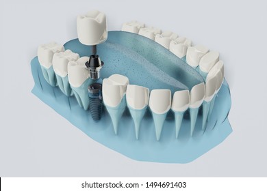 Close Up Component Of Dental Implants. Blue Color Transparent. 3D Illustration, 3D Rendering.