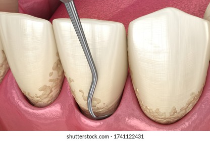 Closed curettage: Scaling and root planing (conventional periodontal therapy). Medically accurate 3D illustration of human teeth treatment