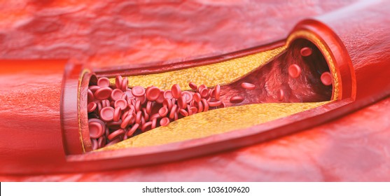 Closeup of a atherosclerosis - 3D rendering