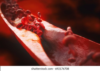 Closeup of a atherosclerosis- 3D rendering
