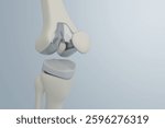 Close-up of knee joint with metal implant in a medical setting. 3D rendering