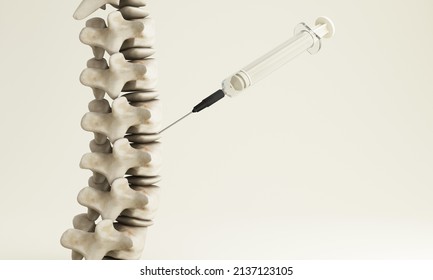 Close-up View Human Spine And Bone Joints. With The Syringe That Is Injecting The Spinal Joints. In The Concept Of Health And Bone Health Office Syndrome And Healing Isolated On White 3d Render