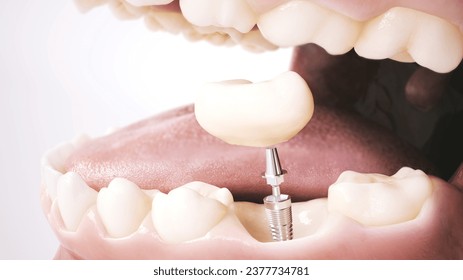 Close-up view of a mouth displaying detailed teeth with a visible dental implant. This image represents the intermediate step in dental restoration, marking it as the second part in a series. - Powered by Shutterstock