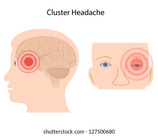 Cluster Headache