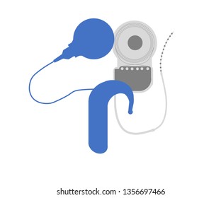 Cochlear Implant System