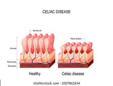 Coeliac Disease. Celiac Disease. Normal Villi And Villous Atrophy. Small Bowel Showing Coeliac Disease Manifested By Blunting Of Vill. Diagram For Medical Use