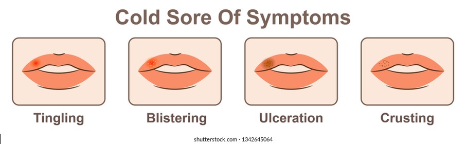 cold sores on lips early stages